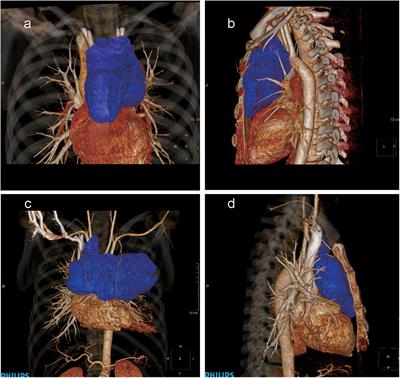 Case report: Reducing the duration of positive-pressure ventilation for large mediastinal masses